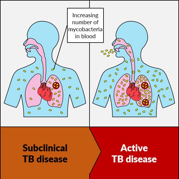 TB Progression in humans
