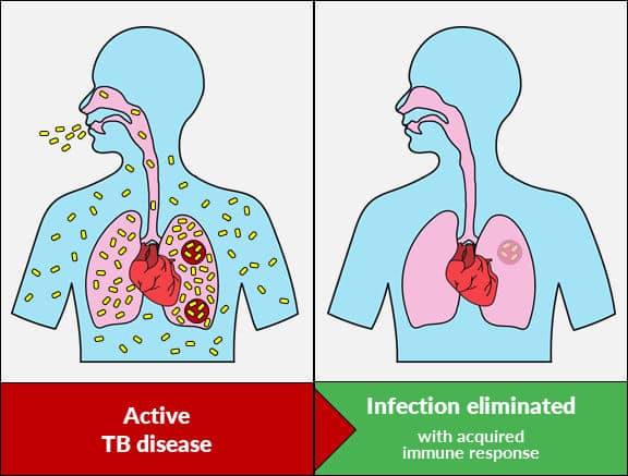 Active TB to eliminated diagram