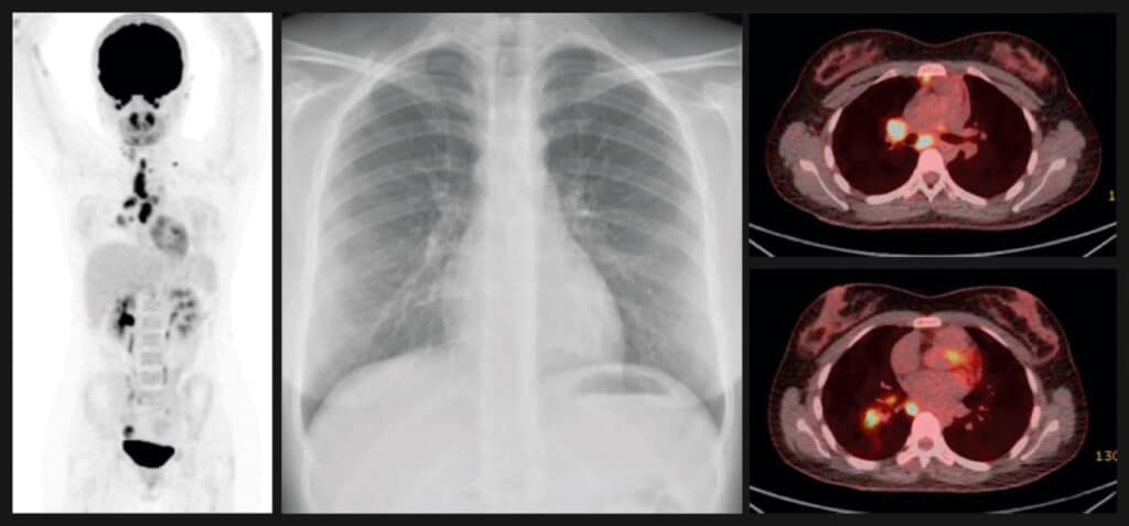 Lancet article - PET-CT features observed following M tuberculosis exposure. biomarkers show those at high risk of TB