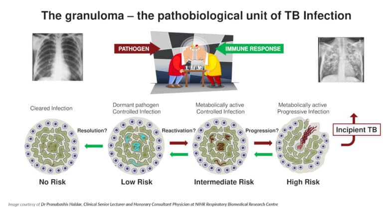 Phage-based diagnostics combined with qPCR offer a highly specific and sensitive approach to developing pathogen-directed markers of TB
